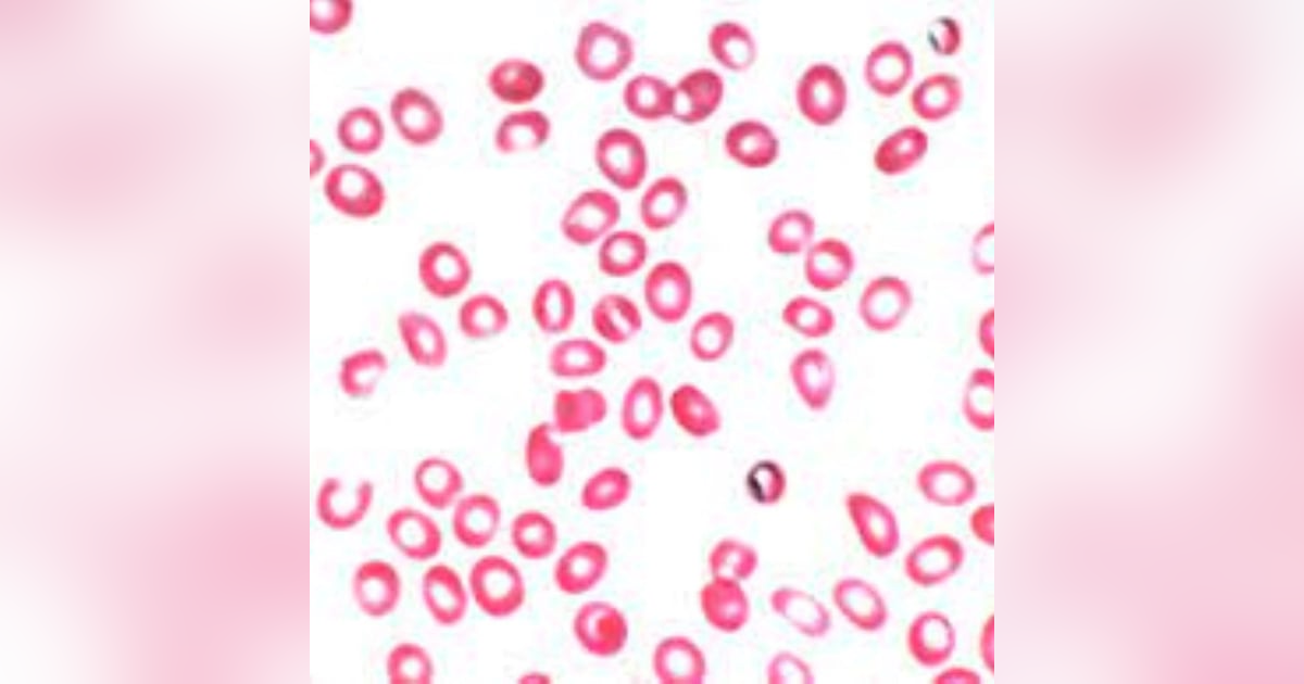 S3 E2: More Than You Ever Wanted to Know: Microcytic Hypochromic Anemia: The Christmas Episode S3 E2: More Than You Ever Wanted to Know: Microcytic Hypochromic Anemia: The Christmas Episode