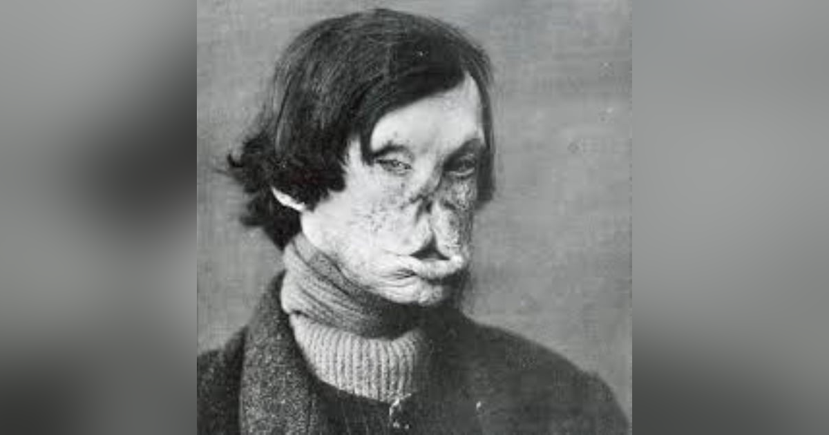 S4 E2: Oh, Holy Stigma: The Story of Leprosy S4 E2: Oh, Holy Stigma: The Story of Leprosy