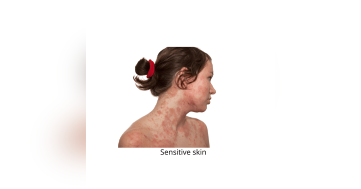 image for How to Care for Sensitive Skin, Eczema, and Psoriasis