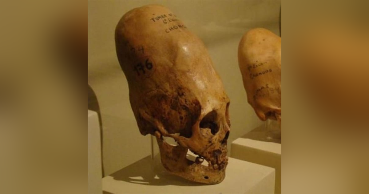 Elongated Skulls: Human or Alien? Elongated Skulls: Human or Alien?