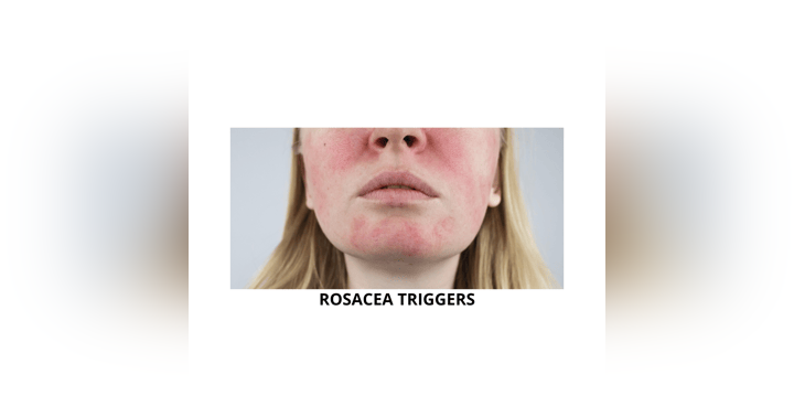 image for Flushing & Blushing: Unpacking Rosacea Triggers and Calming Skincare Ingredients