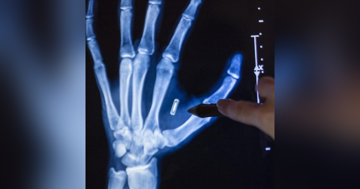 The Invisible Crime: Illegal Microchip Implants and Microwave Technology The Invisible Crime: Illegal Microchip Implants and Microwave Technology