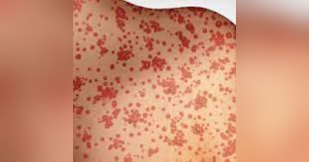 S3 E8: Minor Childhood Disease: The Story of Measles S3 E8: Minor Childhood Disease: The Story of Measles