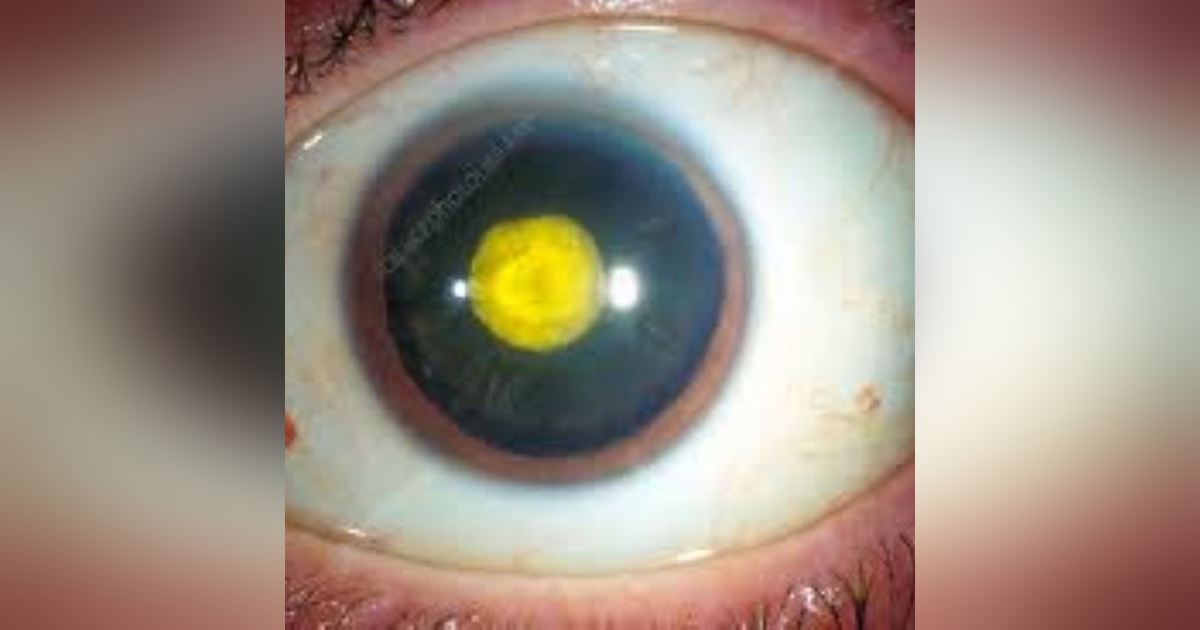 S3 E16: The German Connection: The Story of Rubella S3 E16: The German Connection: The Story of Rubella