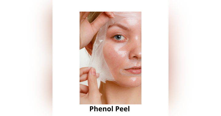 image for The Phenol Peel: The "Once in a Lifetime" Skin Resurfacing Treatment You've Never Heard Of