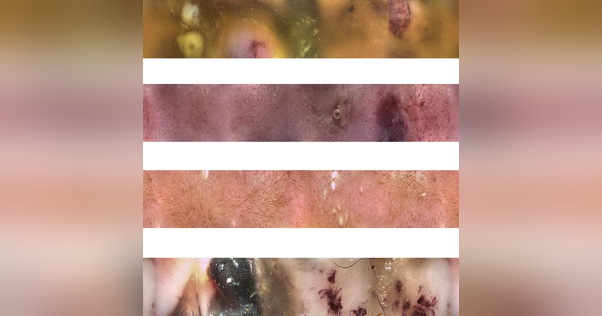 VV Clinical: Next level imaging of the GI tract, with Prof. Alice Defarges. VV Clinical: Next level imaging of the GI tract, with Prof. Alice Defarges.