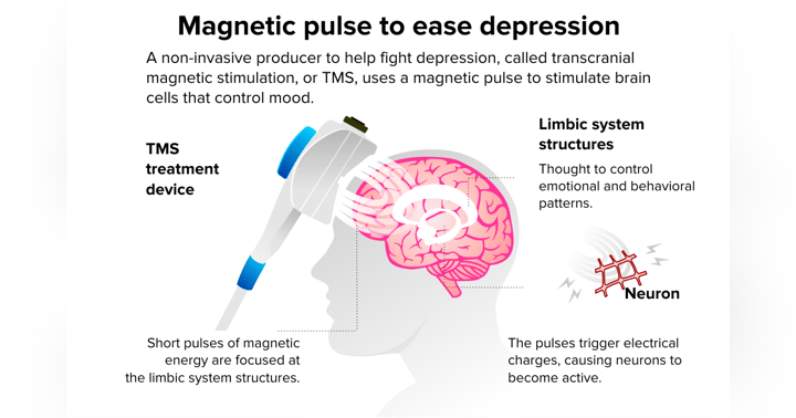 image for Transcranial Magnetic Stimulation: Could This Non-Medication Treatment Help You?