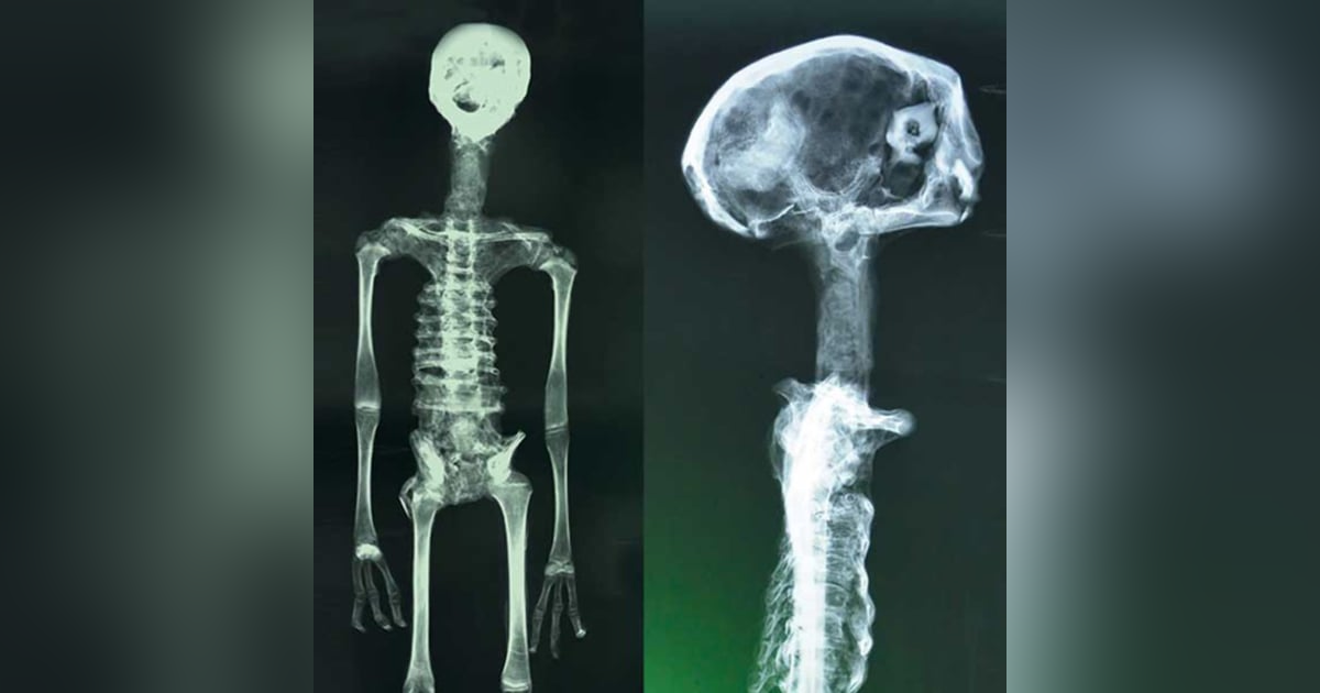 Peruvian Alien Mummies: Paracas Skulls, Starchild Skull, and The Dark Ages of Ufology Peruvian Alien Mummies: Paracas Skulls, Starchild Skull, and The Dark Ages of Ufology