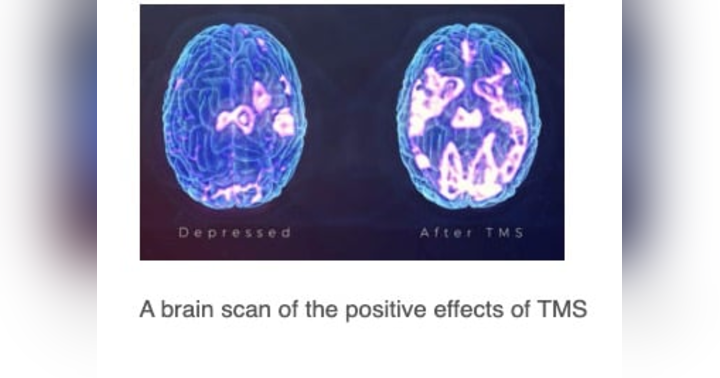 image for An Alternate Therapy For Depression