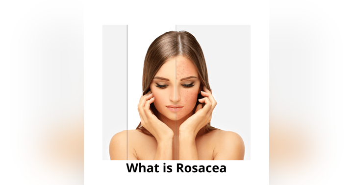 image for Understanding Rosacea: What It Is, How to Identify It, and Ways to Manage It