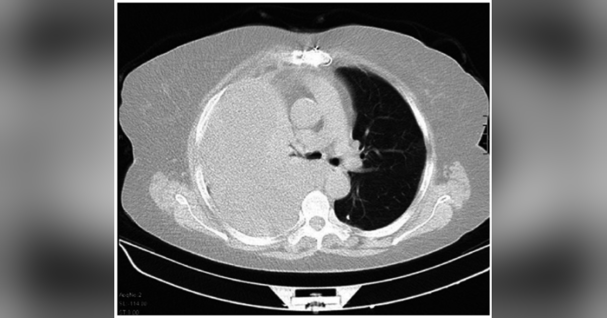 Journal Club: Small-bore vs Large-bore Chest Tube for Hemothorax Journal Club: Small-bore vs Large-bore Chest Tube for Hemothorax