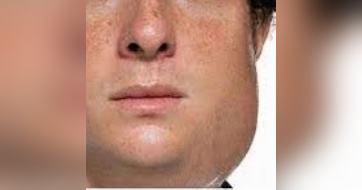 S3E9: Earache My Eye: The Story of Mumps S3E9: Earache My Eye: The Story of Mumps