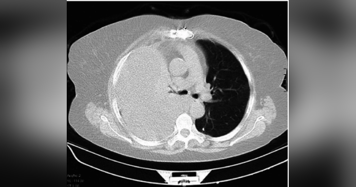 image for Small-bore vs Large-bore Chest Tubes in Hemothorax