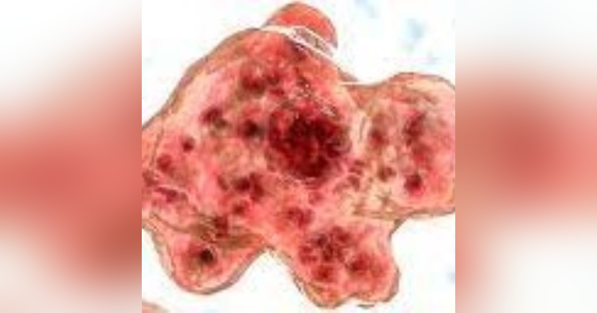 S8 E2: Brain Suckers: The Story of Naegleria fowleri S8 E2: Brain Suckers: The Story of Naegleria fowleri
