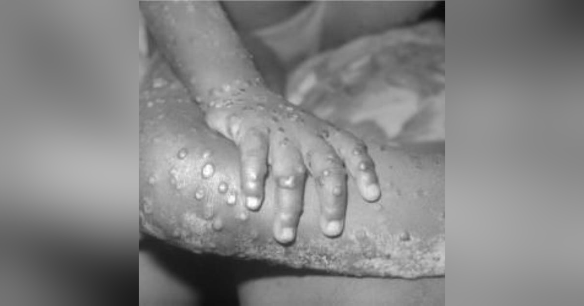 S3 E15: More Than You Ever Wanted to Know: Monkeypox: Q&A S3 E15: More Than You Ever Wanted to Know: Monkeypox: Q&A